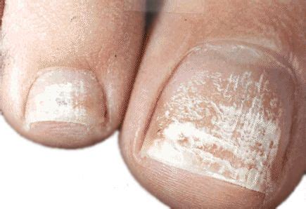 White Toenail Fungus — Nails Turning White Due to Fungal Infection? | White toenail fungus, Nail ...