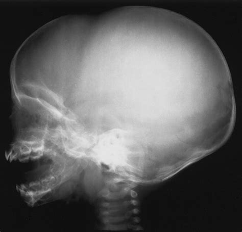 The Infant Skull: A Vault of Information | RadioGraphics