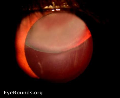 Ectopia lentis. EyeRounds.org: Online Ophthalmic Atlas