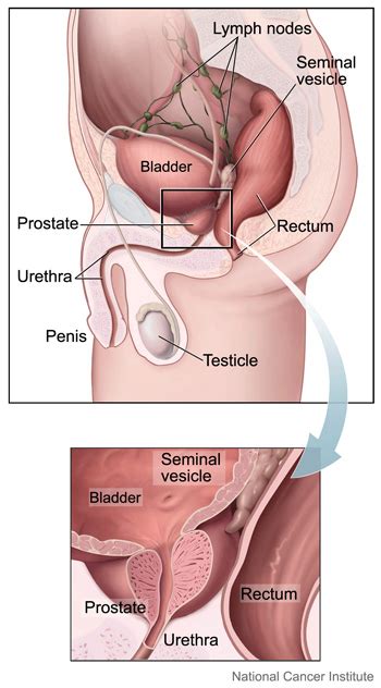 Understanding Prostate Cancer | Knight Cancer Institute | OHSU