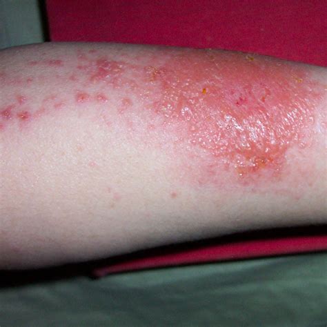 30 Common Skin Rashes: Pictures, Symptoms, and Treatment