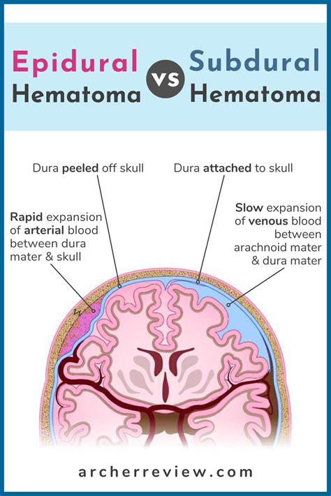 NCLEX Tip: Subdural vs Epidural Hematomas in 2022 | Nclex, Nursing ...