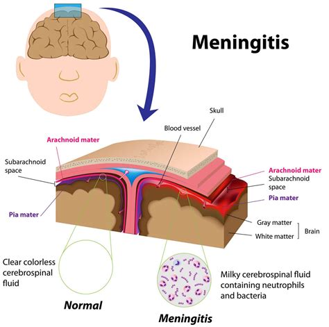 Meningitis Symptome, Ursachen und Behandlung der Hirnhautentzündung