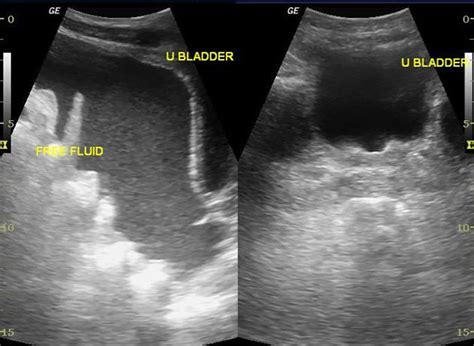 Paracentesis Procedure - Abdominal Paracentesis Position, Complications