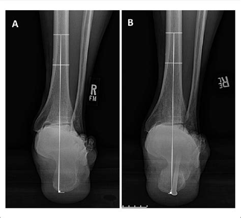 Hindfoot Alignment View X Ray