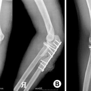 (PDF) Monteggia Fractures in Children and Adults