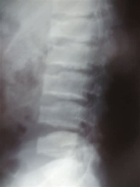 SPONDYLOEPIPHYSEAL DYSPLASIA TARDA(X-Linked spondyloepiphyseal ...