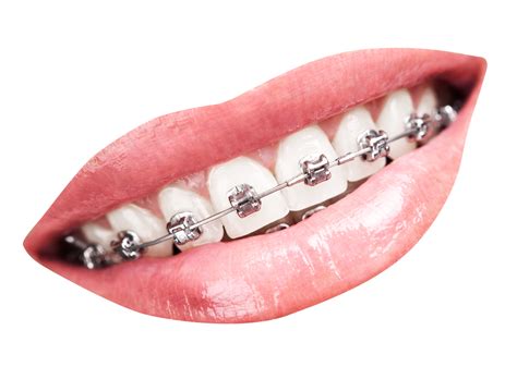 Braces Cartoon Png Vector Psd And Clipart With Transp - vrogue.co