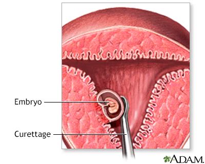 Surgical Abortion