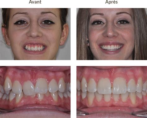 Before And After South Lyon Orthodontics South Lyon MI, 42% OFF