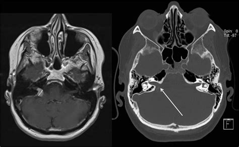 Left: T1WI contrast MRI showing a CPA meningioma invading the right IAC... | Download Scientific ...