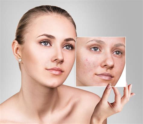 Woman Shows Photo with Bad Skin before Treatment. Stock Image - Image of beauty, blackhead: 96258207