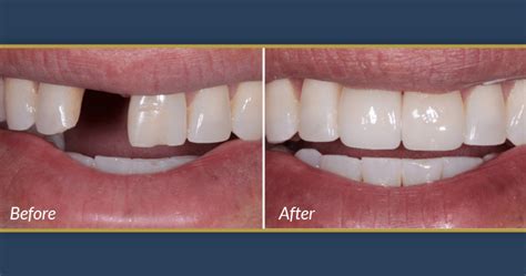 Dental Implants - Confident Smiles