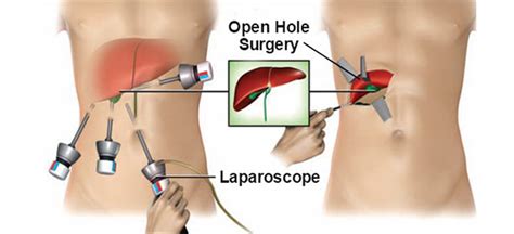 Laparoscopy or Open Surgery, Which one is best?- Southlake General