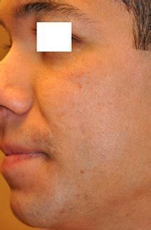 Laser Birthmark Removal Scottsdale AZ | Tempe AZ - Perfect Skin Center