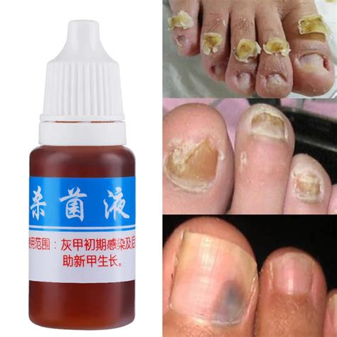 10ml Nail Fungus Treatment Cream Onychomycosis Paronychia Anti Fungal ...