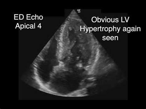 Hypertrophic Obstructive Cardiomyopathy with SAM - YouTube