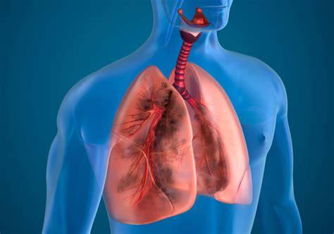 Lung Disease – Pulmonary Practice