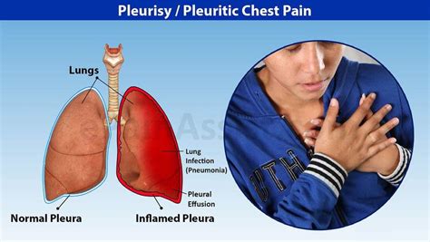 Pleurisy Treatment In Homeopathy - Homeopathic Medicine And Treatment In Hindi