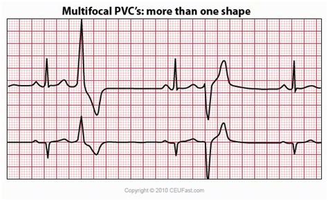 CEUfast.com - multifocal pvc | Heart ️ Stuff | Pinterest | Cardiac anatomy and Cardiovascular ...