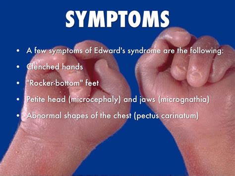 edwards syndrome symptoms - DriverLayer Search Engine