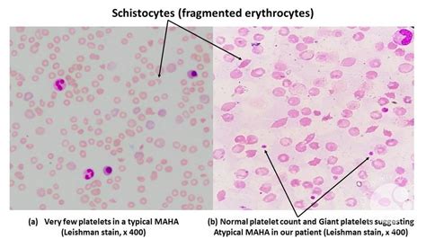 Atypical Microangiopathic Hemolytic Anemia: Case report