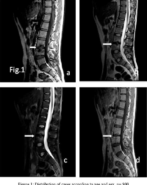 Ankylosing Spondylitis Mri