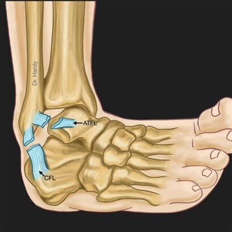 This figure shows a combined rupture of both Anterior TaloFibular ...