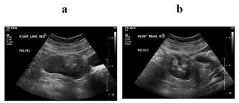 Right pelvic kidney on Renal Ultrasound. a) Longitudinal View, b)... | Download Scientific Diagram