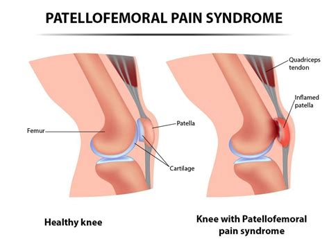 Patellofemoral Pain Syndrome (PFPS) Treatment NJ & NYC | Patellofemoral Specialist New jersey