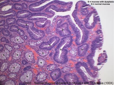 C – High Grade Dysplasia Adjacent to Normal Colon Mucosa – 100X