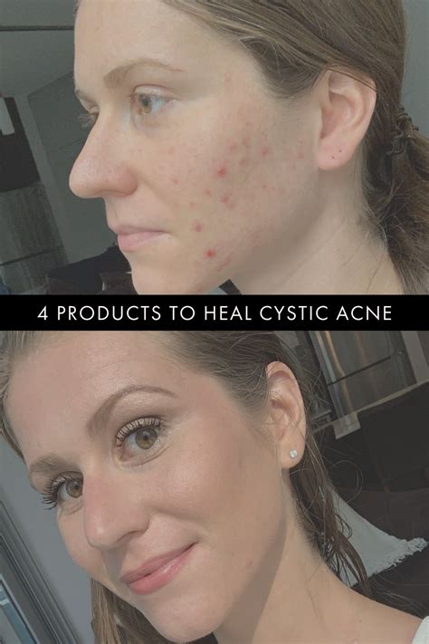 4 products that heal & prevent cystic acne by controlling oil AND moisturizing in 2020 | Cystic ...