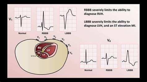 Intro to EKG Interpretation - Bundle Branch Blocks - YouTube