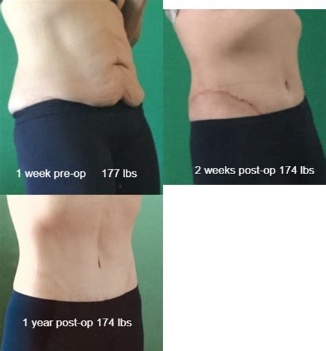 Circumferential Abdominoplasty (360° tummy tuck) One year post-op scar ...