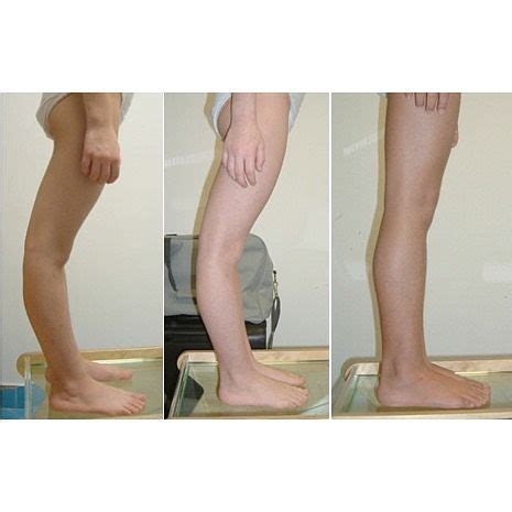 Genu recurvatum is a deformity in the knee joint so that the knee bends ...