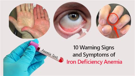 10 Warning Signs and Symptoms of Iron Deficiency Anemia