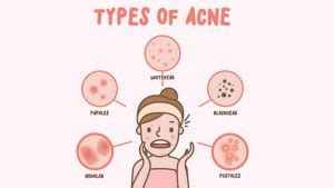 Pitted Acne Scars – Causes and Treatment Options – Entirely Health