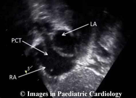 Transthoracic echocardiogram of infant. Subcostal left anterior oblique ...