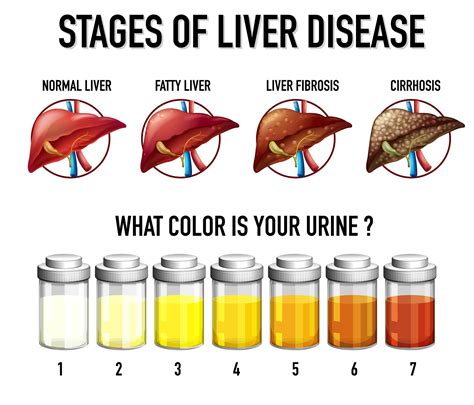 Stages of liver disease 1868462 Vector Art at Vecteezy