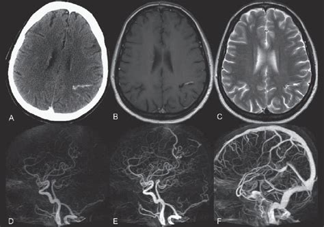 Arteriovenous Malformation Mri