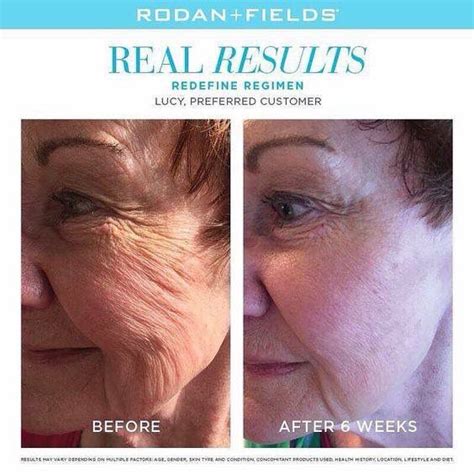 20 Rodan and Fields Before and After Pictures That Will Shock You | The ...