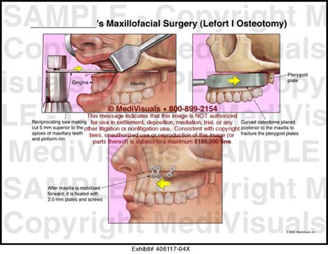 Maxillofacial Surgery - LeFort I Osteotomy Medical Exhibit