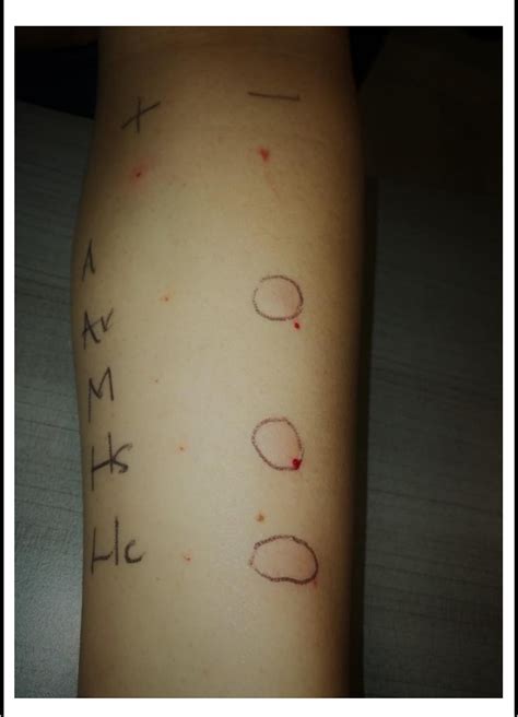 Figure 3 from Immunotherapy in Anaphylaxis by Tropical Fire Ant Sting ...