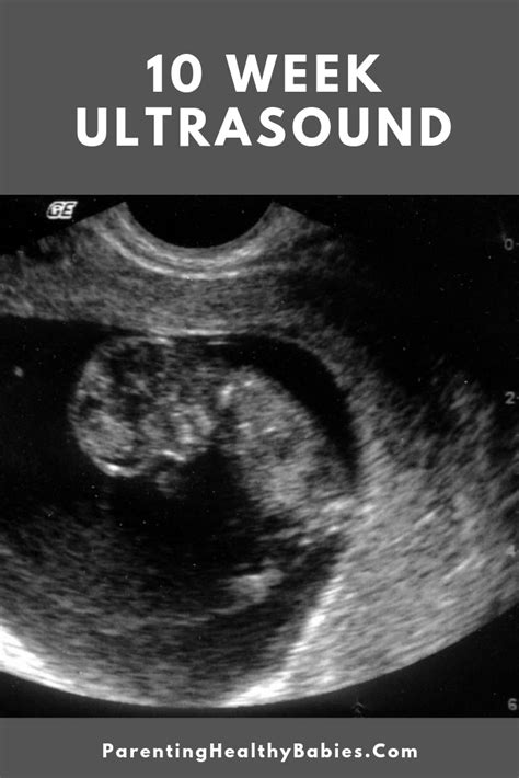 10 Week Ultrasound: All You Need to Know As A New Mom To Be | Ultrasound gender prediction, 10 ...