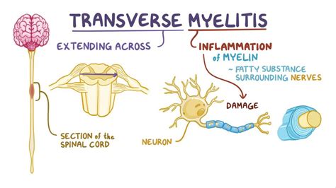 Transverse myelitis: Video, Anatomy & Definition | Osmosis