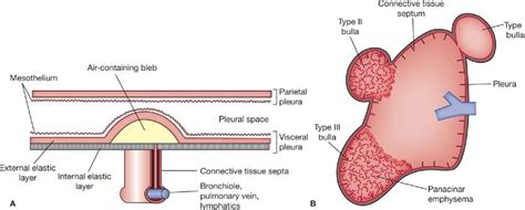 Bullous Disease of the Lung | Thoracic Key