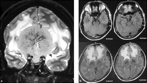 Complications in the Management of Skull Base Meningioma | Neupsy Key