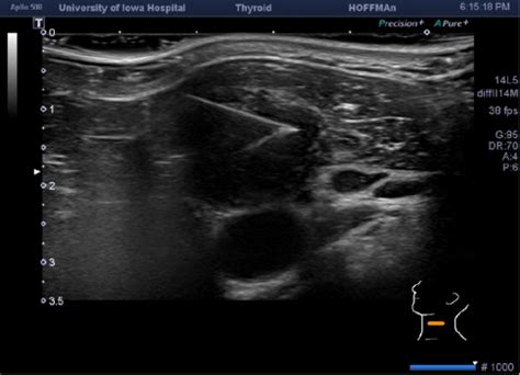 Salivary Ultrasound Guided FNA Fine Needle Aspiration Biopsy | Iowa Head and Neck Protocols