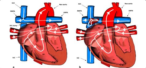 a Appearances of the heart after the bi-directional Glenn procedure ...