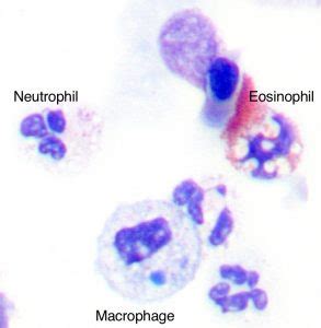 Asthma Phenotyping | Severe Asthma Toolkit